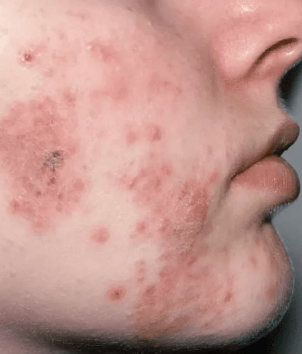 Acne vulgaris