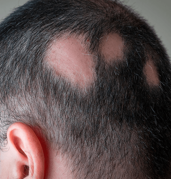 Alopecia areata