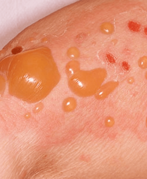 Bullosus pemphigoid