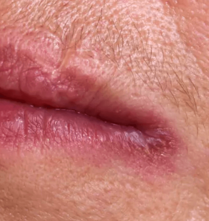 Cheilitis angularis