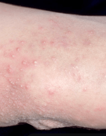 Dermatitis herpetiformis Duhring