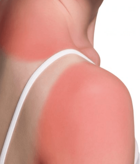 Dermatitis solaris
