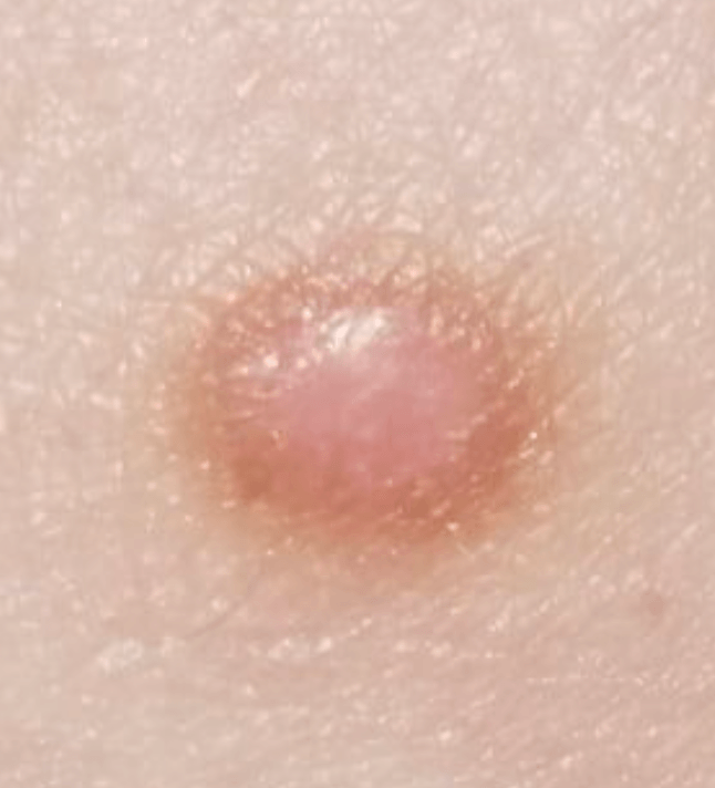 Dermatofibroma