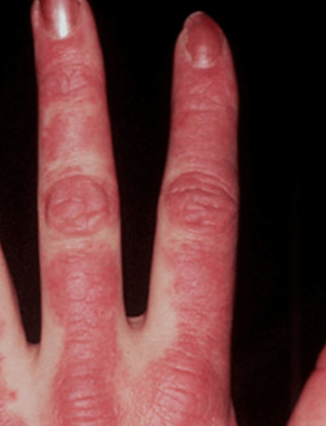 Dermatomyositis