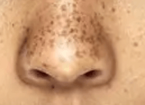 Ephelis