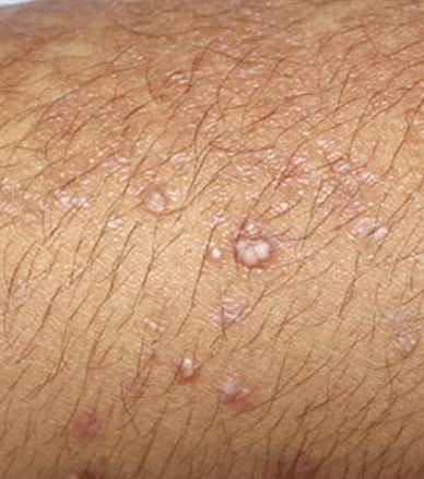 Epidermolysis bullosa hereditera