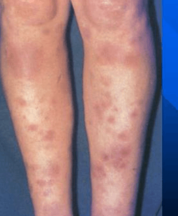 Erythema nodosum