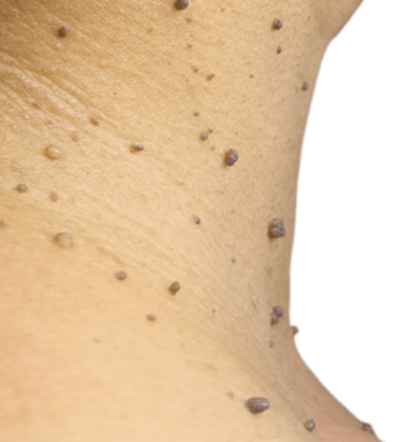 Lágy fibroma
