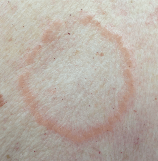 Granuloma anulare