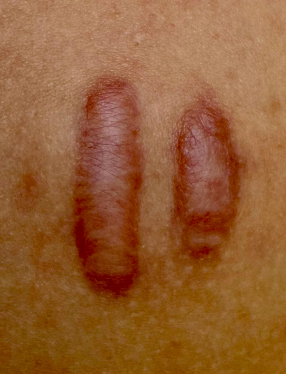 Keloid