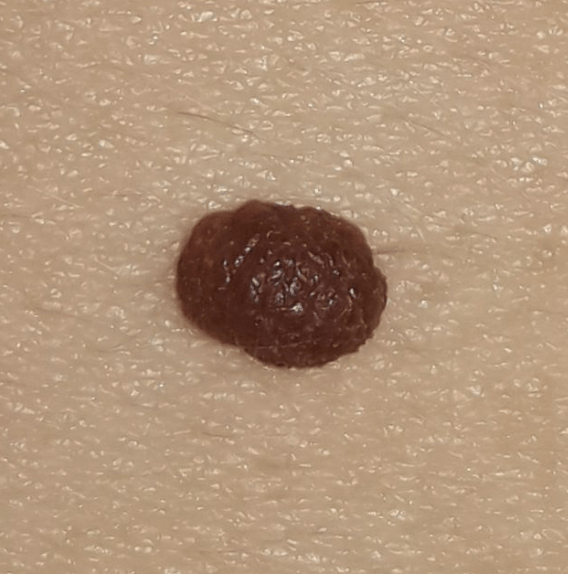 Intradermalis naevus
