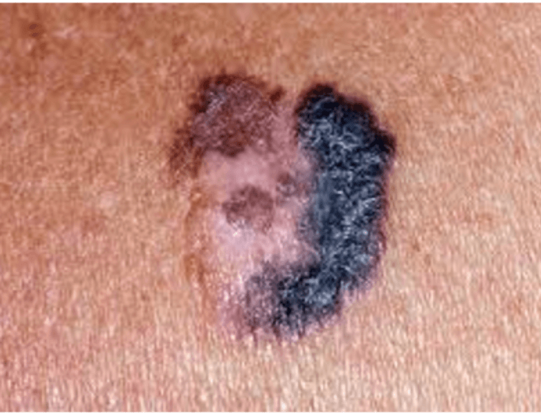 Superficialis terjedésű melanoma
