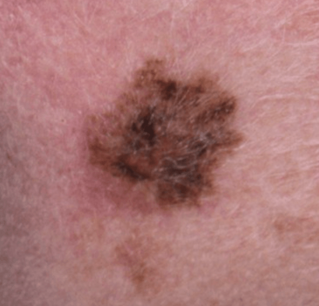 Lentigo maligna melanoma