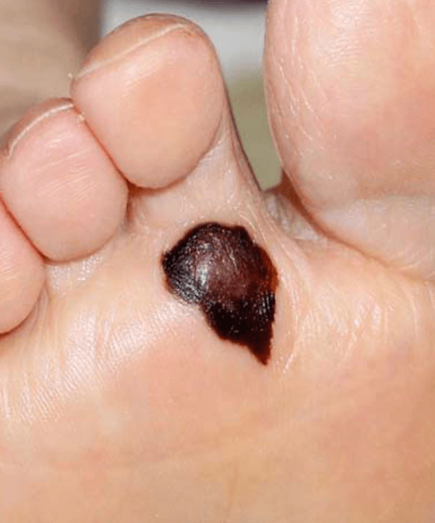 Acralis lentiginosus melanoma