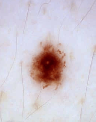 Melanoma in situ