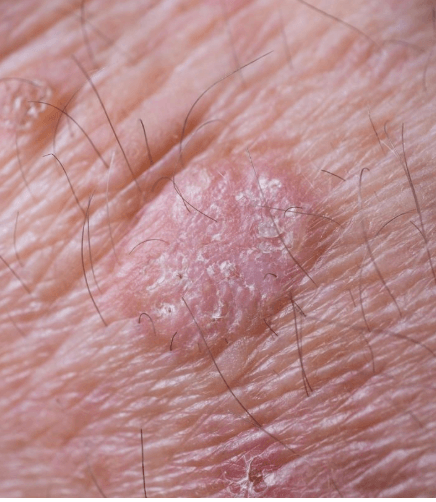 Aktinikus keratosis