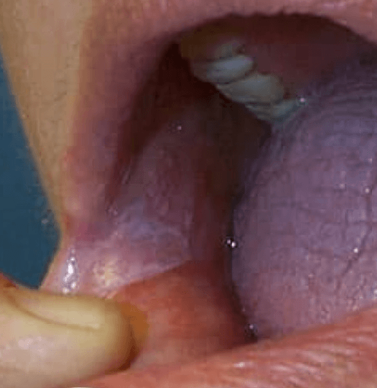 Lichen planus