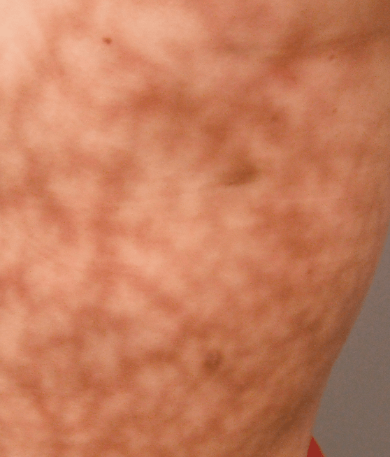 Livedo reticularis