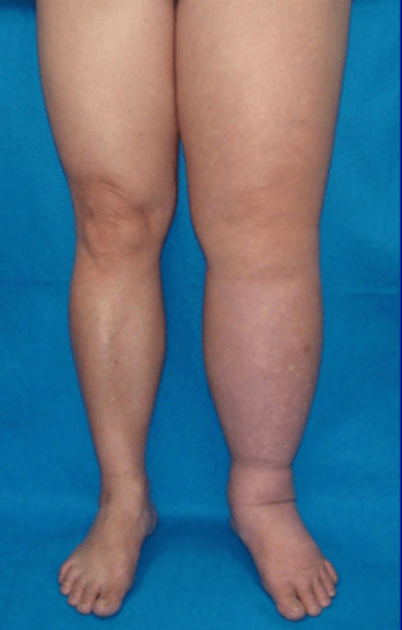 Lymphoedema