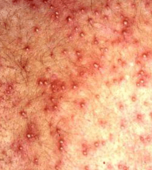 Miliaria