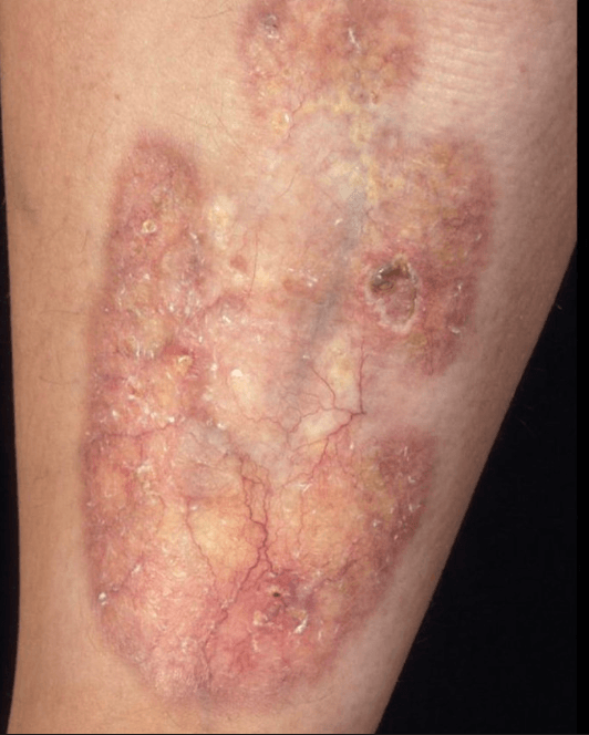 Necrobiosis lipoidica