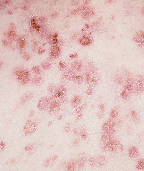 Pemphigus vulgaris
