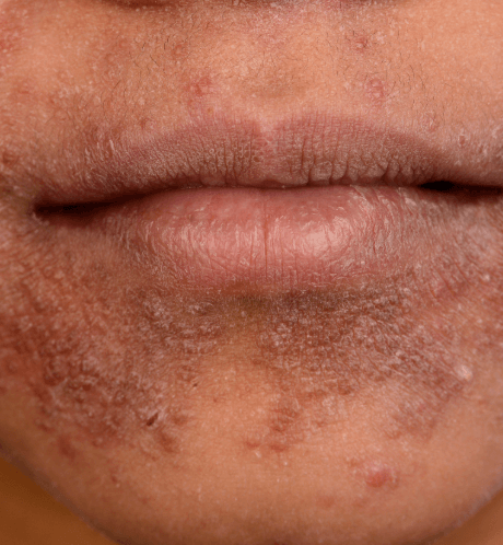 Perioralis dermatitis