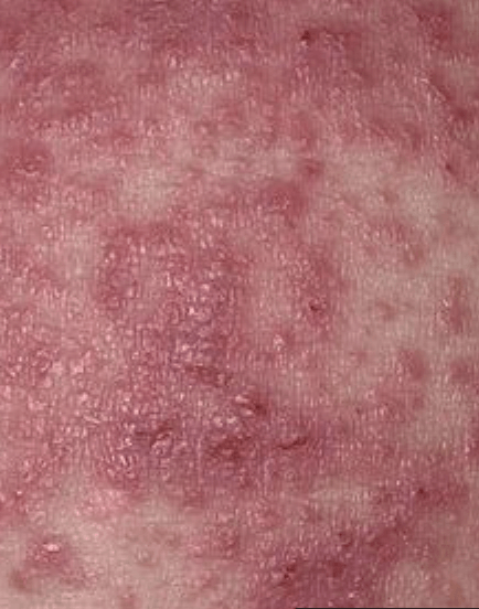 Pityriasis rubra pilaris