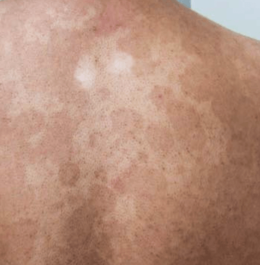 Pityriasis versicolor