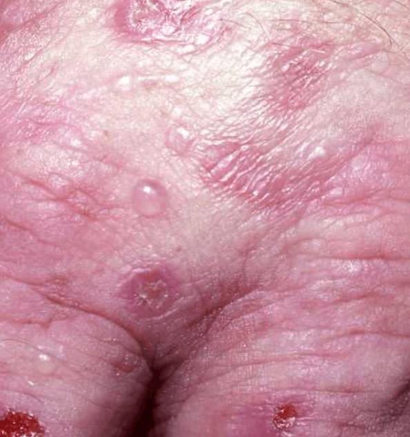 Porphyria cutanea tarda