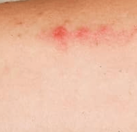 Prurigo simplex