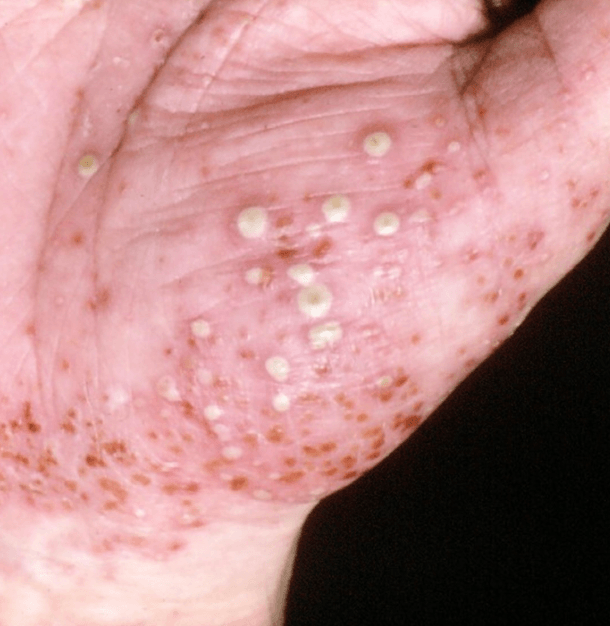 Psoriasis pustulosa