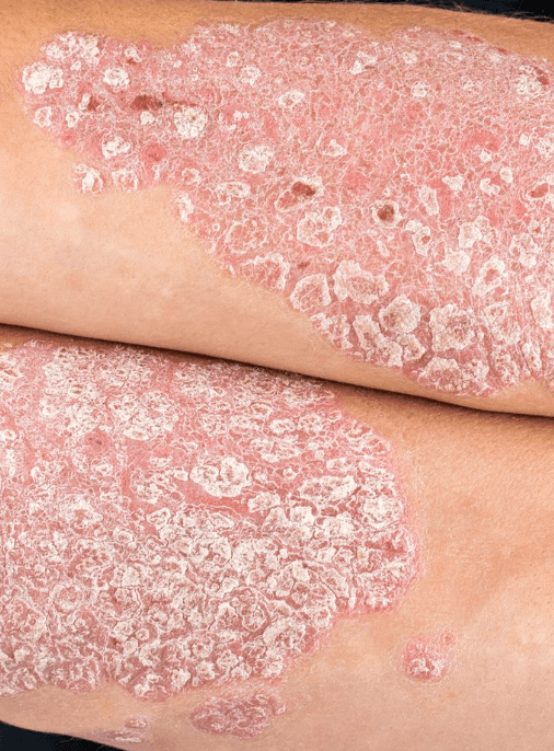 Psoriasis vulgaris