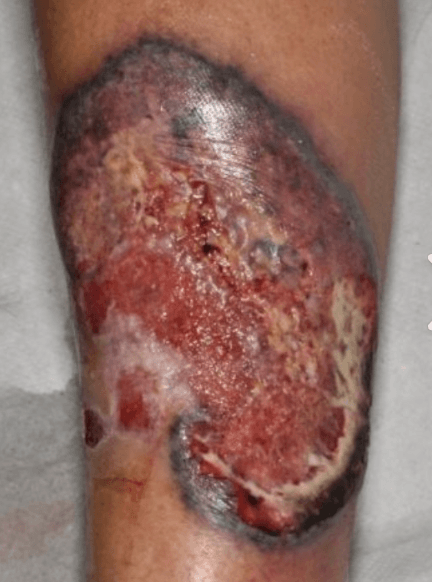Pyoderma gangrenosum