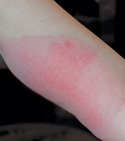 Radiodermatitis