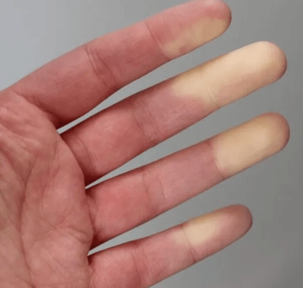 Raynaud-szindróma