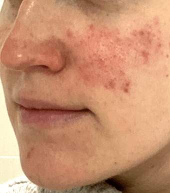 Rosacea