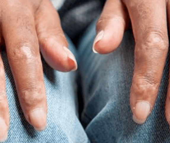 Scleroderma