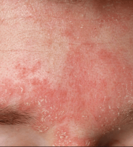 Seborrhoeas dermatitis