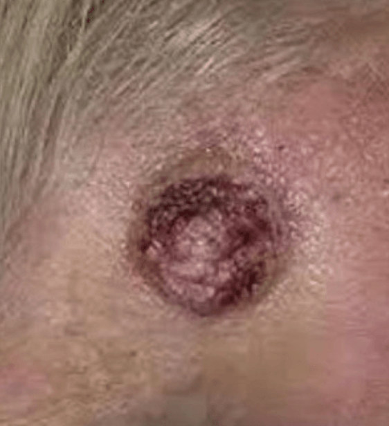Spinalioma