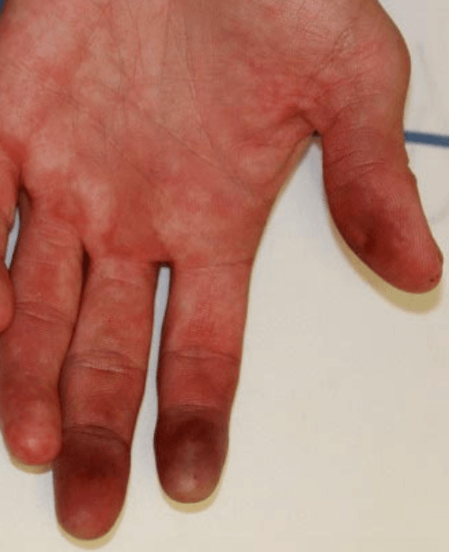 Thrombangitis obliterans