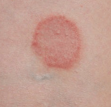Tinea