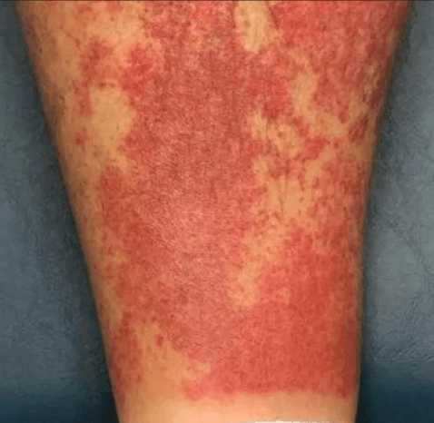 Vasculitis