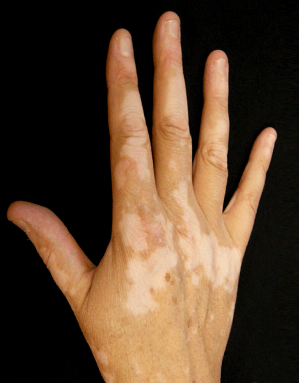 Vitiligo
