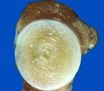 Atheroma