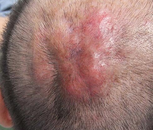 Dermatofibrosarcoma protuberans