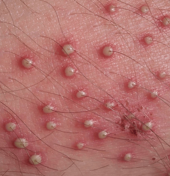Folliculitis