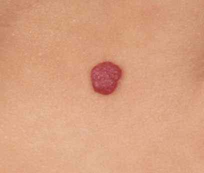 Haemangioma