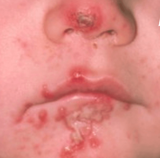 Impetigo