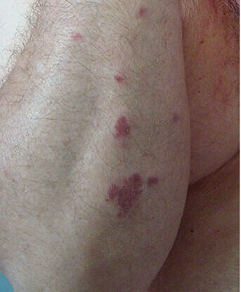 Kaposi-sarcoma